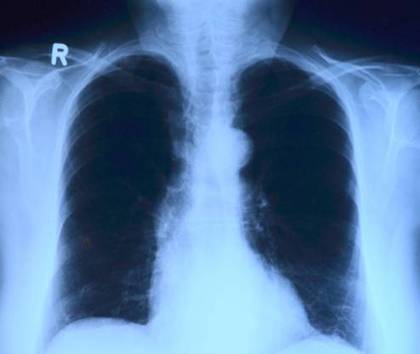 raio x pulmão torax toubibe pixabay