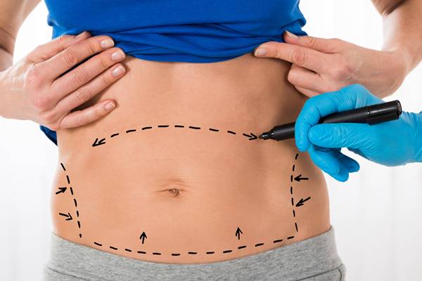 Surgeon Hands Drawing Correction Lines On Stomach